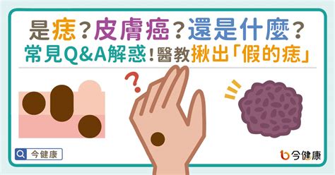 臉上多了痣|是痣？皮膚癌？還是什麼？常見Q&A解惑！醫教揪出「。